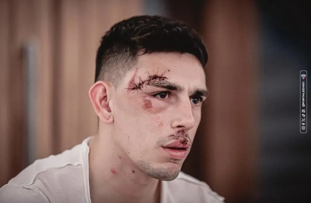 Gonzalo Escobar fica com cicatrizes. Foto: Mateus Lotif/Fortaleza EC